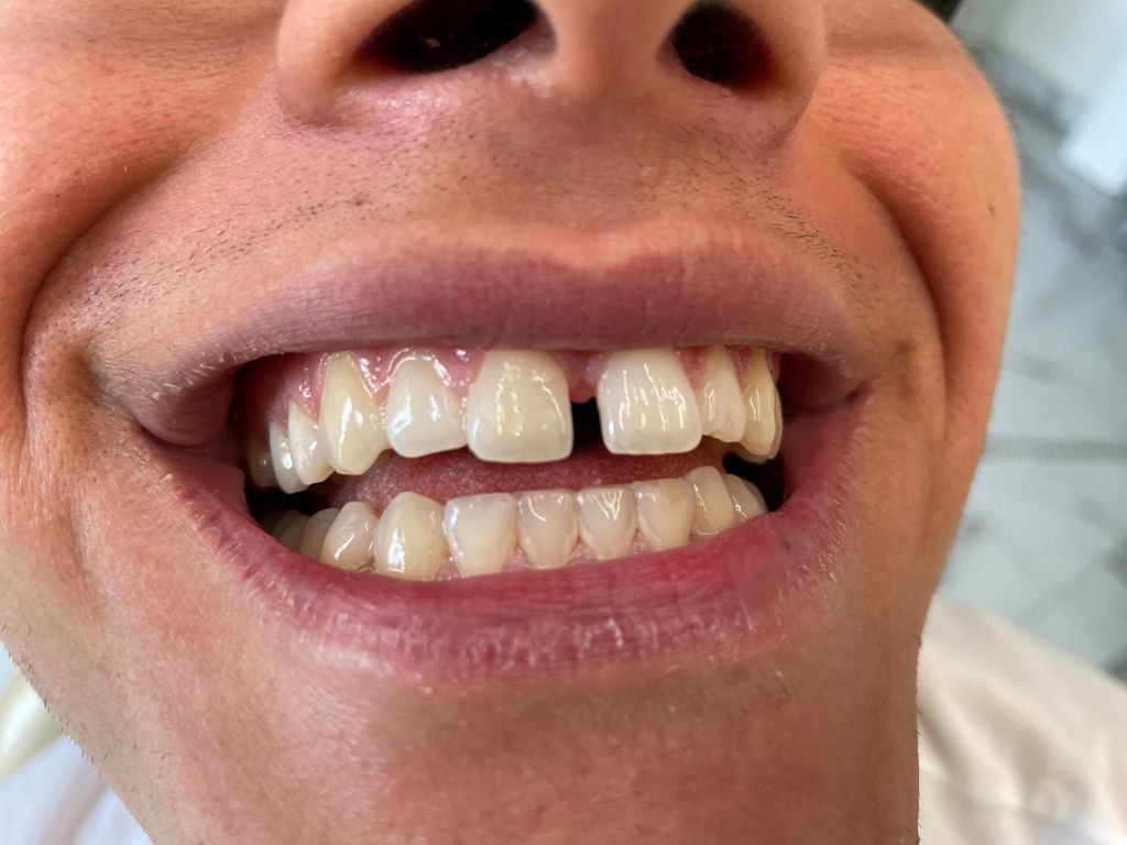 diastema